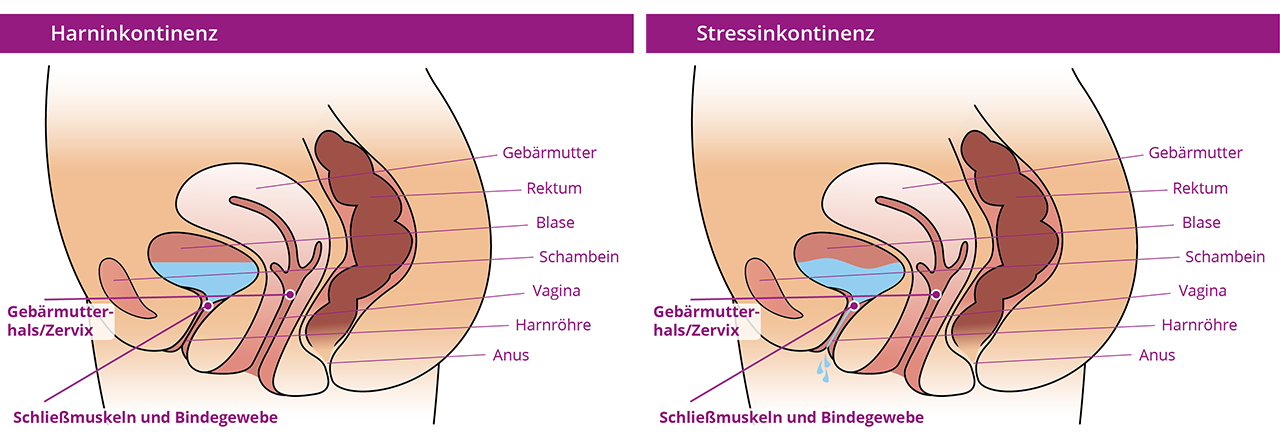 illustration-restifem_harninkontinenz_mod