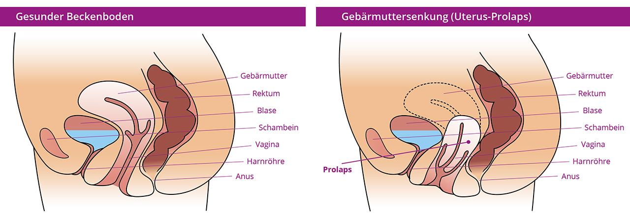 Illustration of residual uterine prolapse