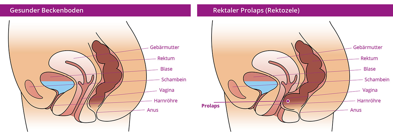 Illustration residual rectal prolapse