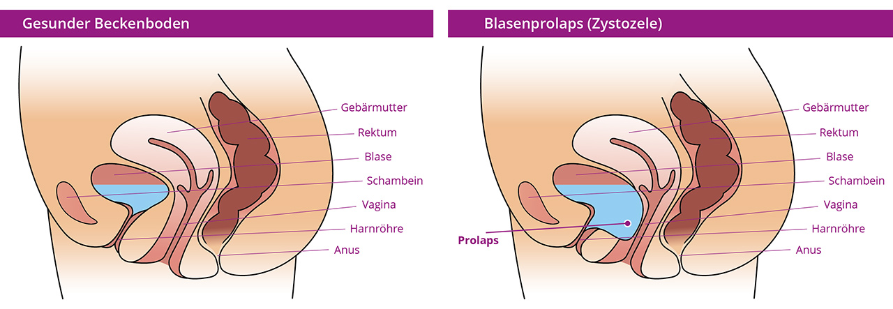 Illustration of residual bladder prolapse