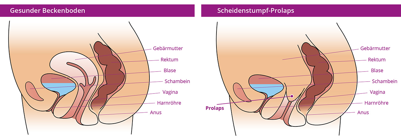 Illustration of residual vaginal stump prolapse